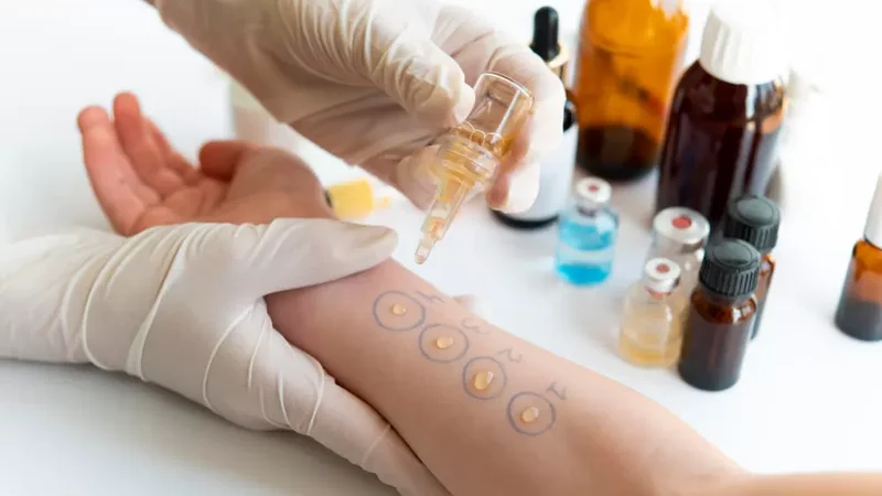 Medicina Imunoalergologia